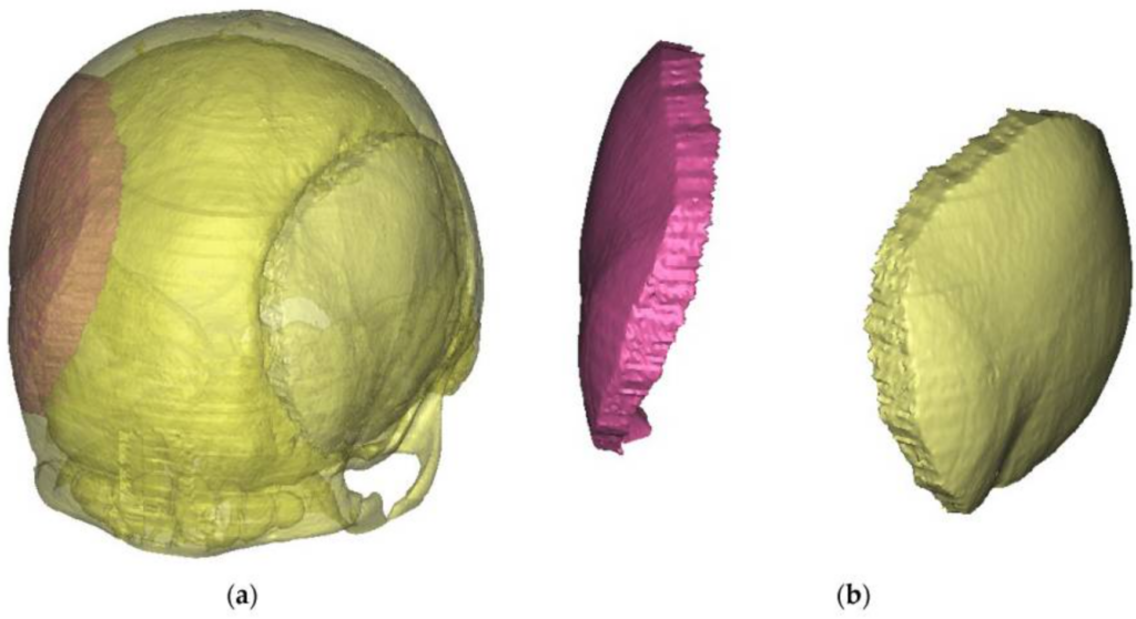 3D printing in the medical industry - Craniofacial reconstruction preparation and techniques